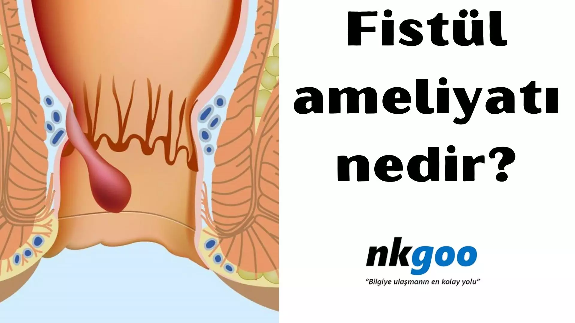 Fistül ameliyatı nedir? Nasıl yapılır? 6 aşaması