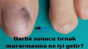 Darbe sonucu tırnak morarmasına ne iyi gelir