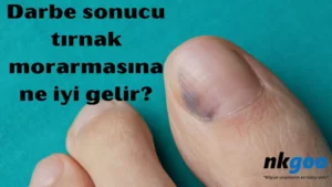 Darbe sonucu tırnak morarmasına ne iyi gelir 